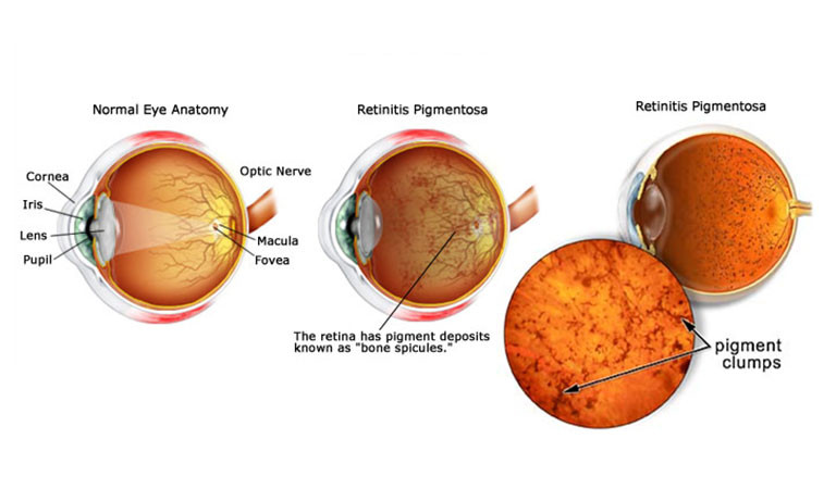 Retinitis Pigmentosa
